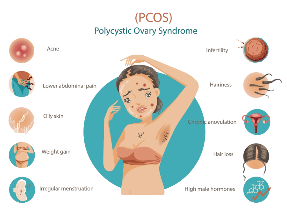PCOS symptom illustration showing irregular periods, acne, excess hair growth and other possible features